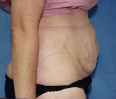Stretch marks on the skin (striae)