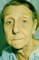 Pernicious anemia causing pallor