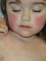 Erythema (skin redness)