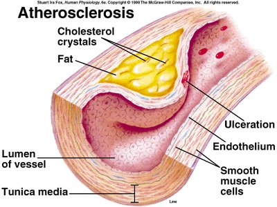 Atherosclerosis: plaque formation in an artery