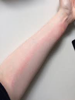 Red streaks of lymphangitis on forearm