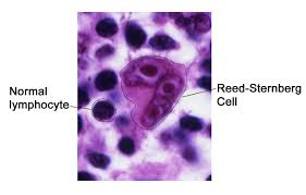 Microscopic image of Reed-Sternberg cell in Hodgkin lymphoma