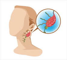 Swollen lymph node in the neck