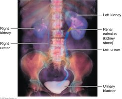 IVP showing kidney stone