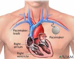 X-ray of pacemaker in chest