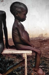 Starved child in relief camp during Nigerian–Biafran war