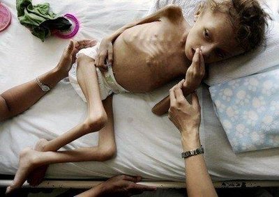 Severely malnourished child