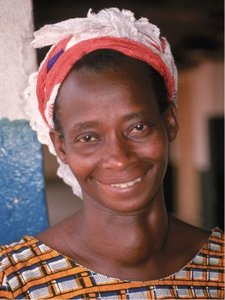 Photograph of a person with a goiter (enlarged thyroid gland)