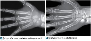 Epiphyseal cartilage and epiphyseal line in x-rays