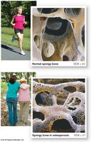 Normal and osteoporotic spongy bone