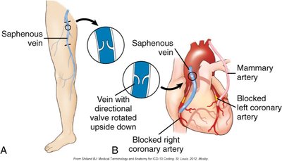Coronary artery bypass grafting