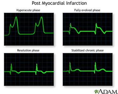 ECG changes in myocardial infarction