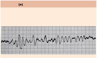 Ventricular fibrillation ECG