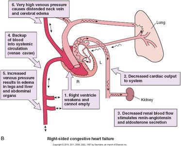 Right-sided congestive heart failure