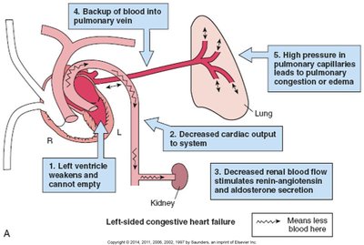 Left-sided congestive heart failure