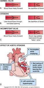 Valvular defects and effects