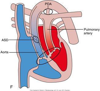Tetralogy of Fallot diagram