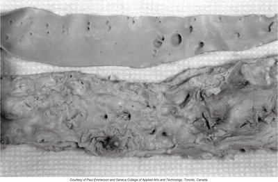 Normal vs. atherosclerotic aorta