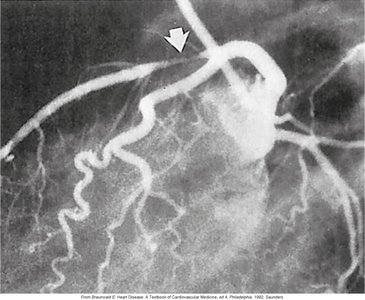 Consequences of atherosclerosis