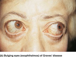 Thyroid disorders: exophthalmos in Grave's disease