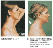 Cushing's syndrome: moon face and buffalo hump