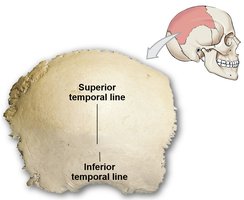 Parietal bone with labeled temporal lines