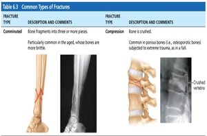 Common types of fractures: comminuted and compression