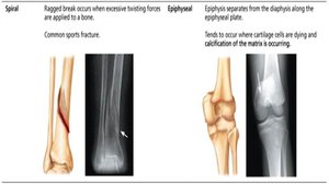 Common types of fractures: spiral and epiphyseal