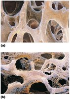 Normal bone vs. osteoporotic bone