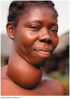 Goiter due to thyroid disorder