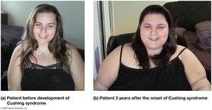 Cushing syndrome: disorder of cortisol secretion