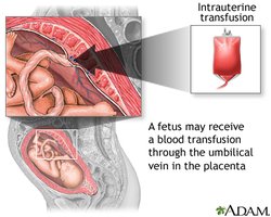 Intrauterine transfusion for hemolytic disease of the newborn