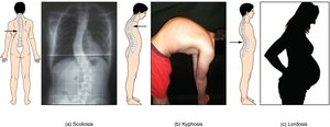 Abnormal curvatures of the vertebral column: scoliosis, kyphosis, and lordosis