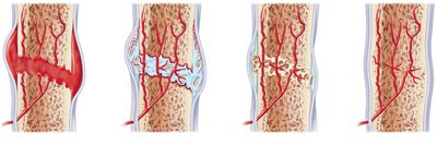 Stages of bone fracture healing