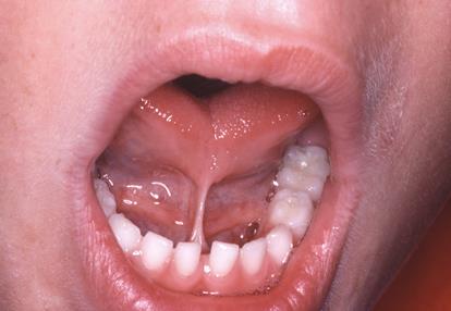 Diagram of salivary glands and ducts in the mouth