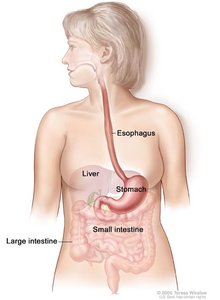 Diagram comparing healthy stomach and GERD stomach
