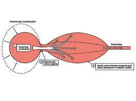 Atherosclerotic plaque in an artery