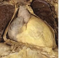 Dissection showing pericardium