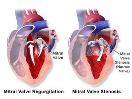 Mitral valve regurgitation and stenosis