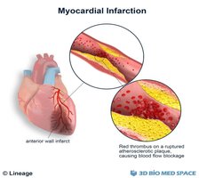 Myocardial infarction and thrombus