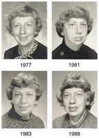 Acromegaly: progressive changes in facial features
