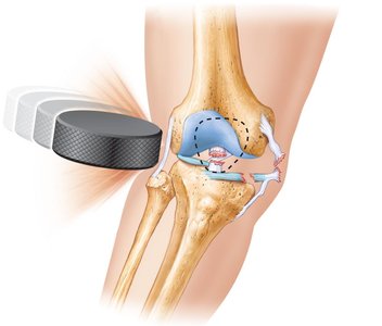 Knee joint injury showing torn ligaments and meniscus