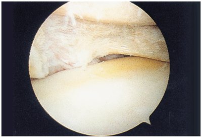Arthroscopic photograph of a torn medial meniscus
