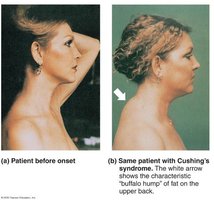 The Effects of Excess Glucocorticoid