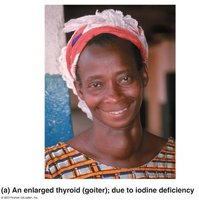 An enlarged thyroid (goiter); due to iodine deficiency