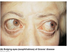 Bulging eyes (exophthalmos) of Graves' disease