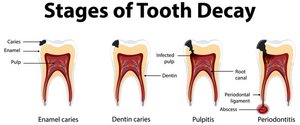 Stages of tooth decay from enamel caries to periodontitis