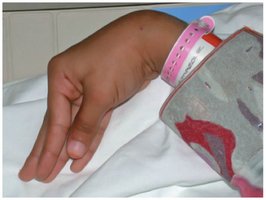 Carpopedal spasm of hypocalcemia