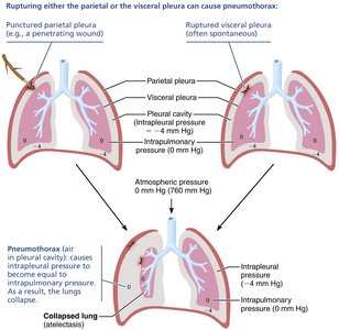 Diagram showing pneumothorax and lung collapse
