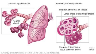 Diagram comparing normal alveoli and fibrotic alveoli